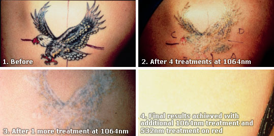 tattoo removal