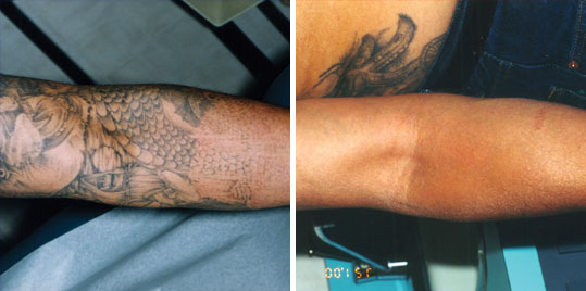 tattoo removal